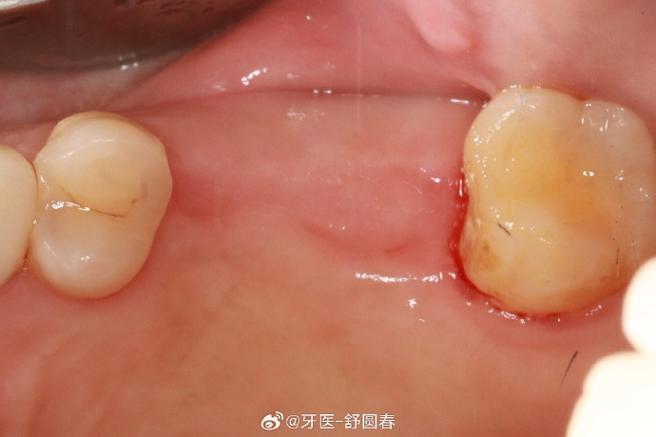 種植即刻修復 舒醫生的診療日常與醫學匠心